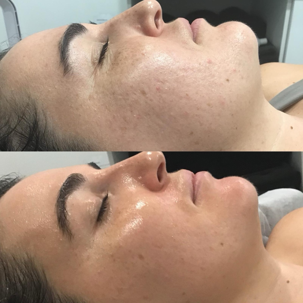 liquid microneedling results