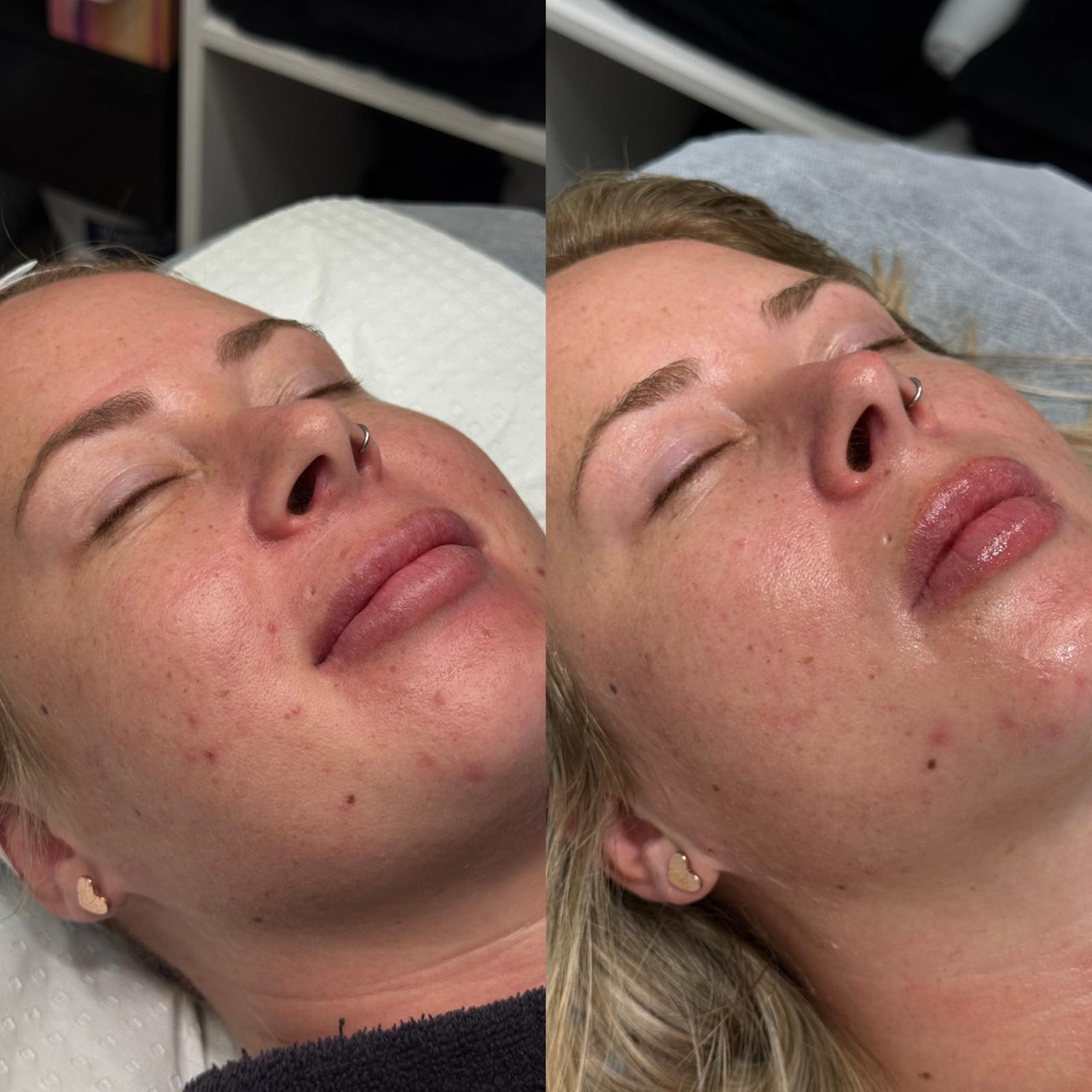 Glassifier liquid microneedling. 