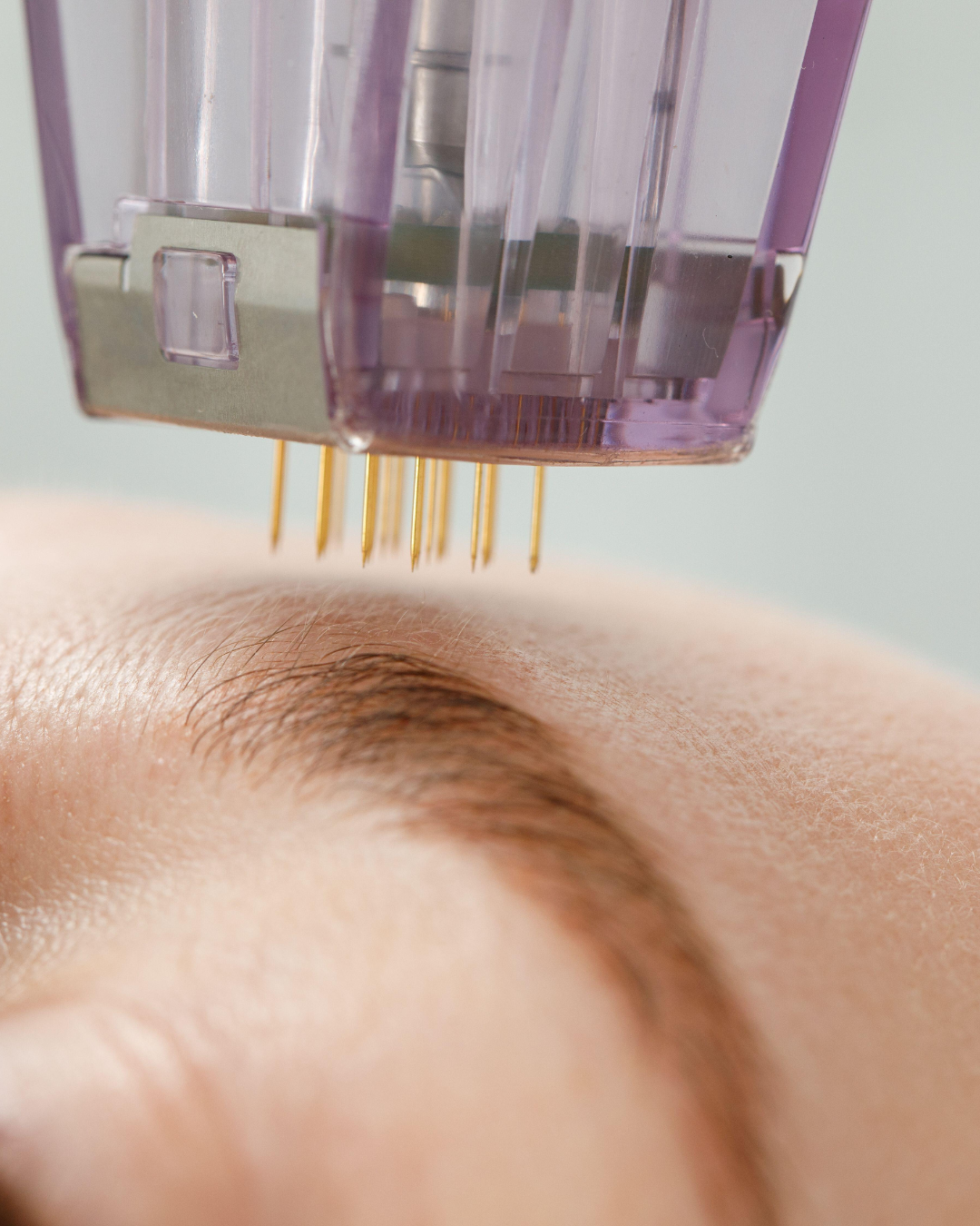 Liquid microneedling. 